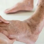 Understanding Chronic Venous Insufficiency and Its Treatment Pathways