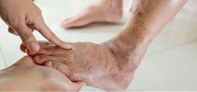 Understanding Chronic Venous Insufficiency and Its Treatment Pathways