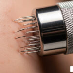 Understanding the Microneedling Process