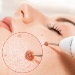 Understanding the Surgical Process of Mohs Surgery