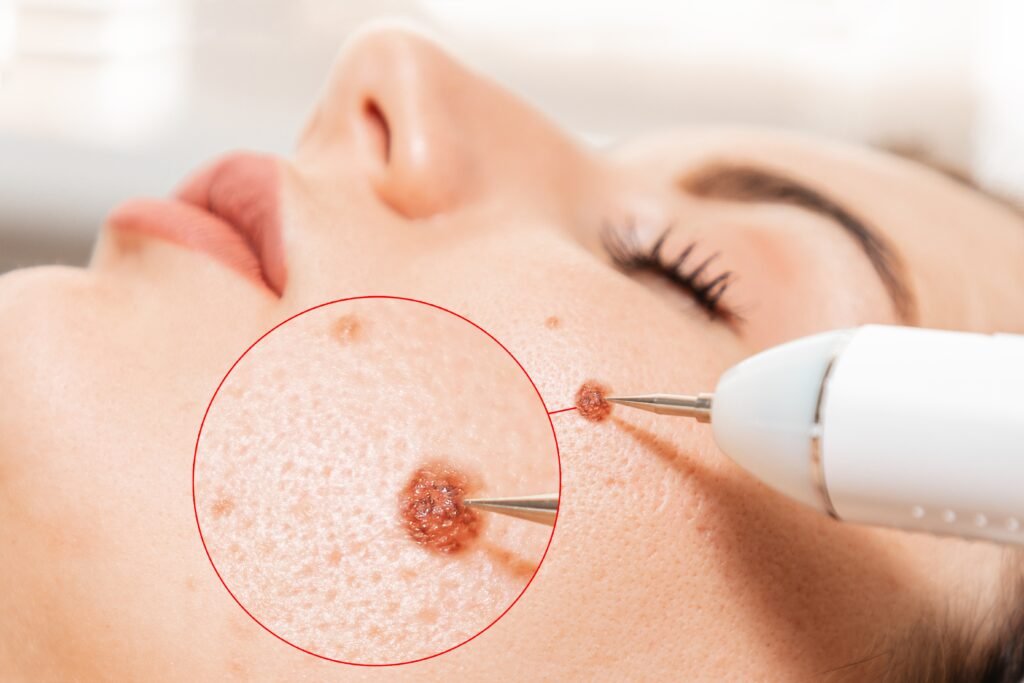 Understanding the Surgical Process of Mohs Surgery