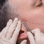 What Is Involved in a Body Hair Transplant?