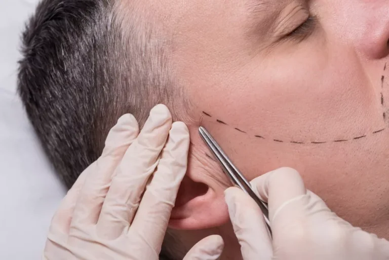What Is Involved in a Body Hair Transplant?