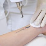 What To Expect During a Tattoo Removal Consultation