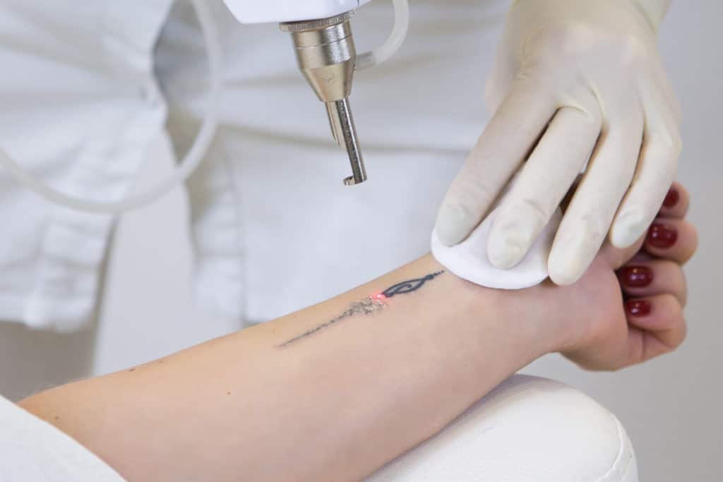 What To Expect During a Tattoo Removal Consultation