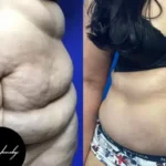 What To Expect From a Tummy Tuck