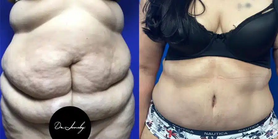 What To Expect From a Tummy Tuck