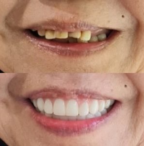 How Dentures Can Transform Your Smile and Improve Your Health