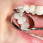 How Fillings Protect Your Teeth From Decay