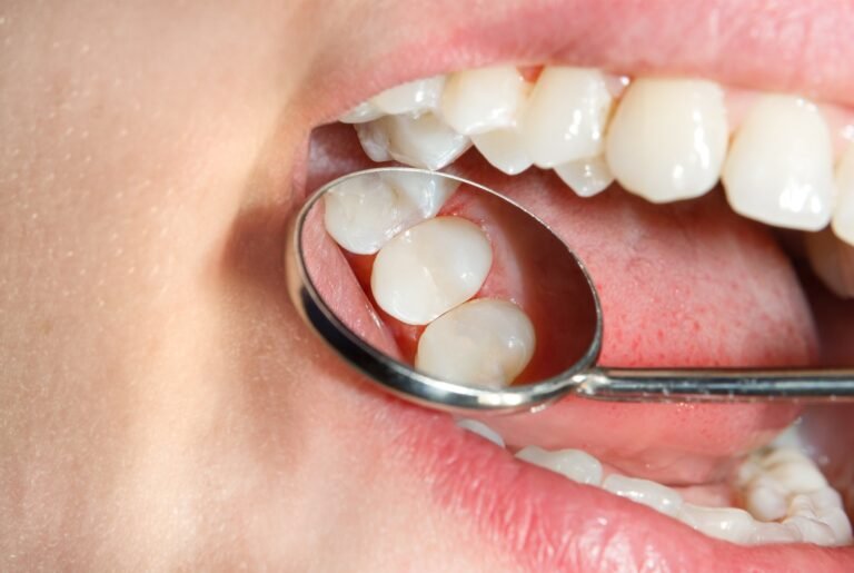 How Fillings Protect Your Teeth From Decay