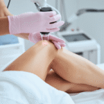 Innovations in Non-surgical Vein Treatment Options