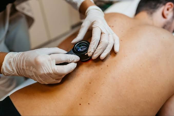 The Role of Mohs Surgery in Skin Cancer Treatment