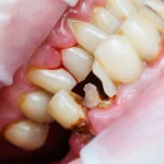 Tips for Caring for Your Broken Tooth