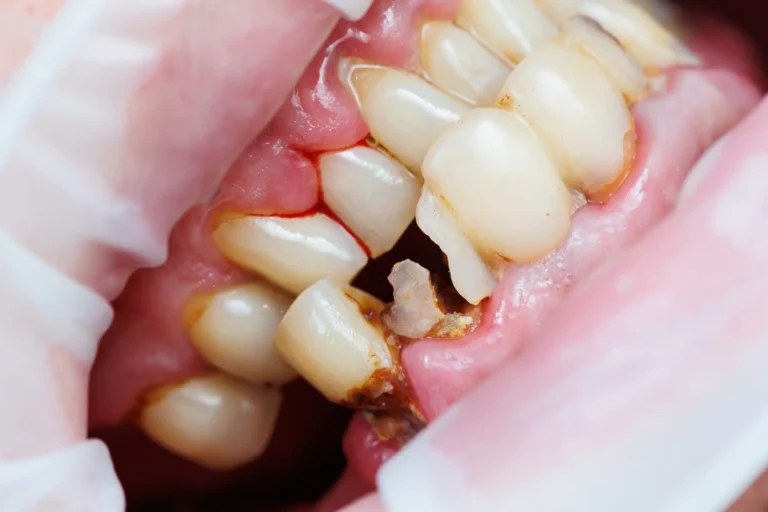 Tips for Caring for Your Broken Tooth