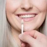 Understanding the Benefits of Veneers for Your Smile