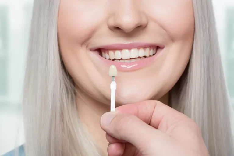 Understanding the Benefits of Veneers for Your Smile