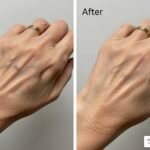 Pre- and Post-Operative Care in Hand Surgery