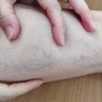 Understanding the Long-term Effects of Varicose Veins