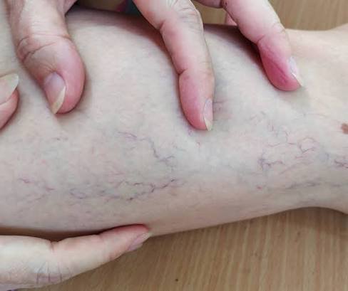 Understanding the Long-term Effects of Varicose Veins