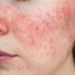 Understanding the Triggers and Symptoms of Rosacea