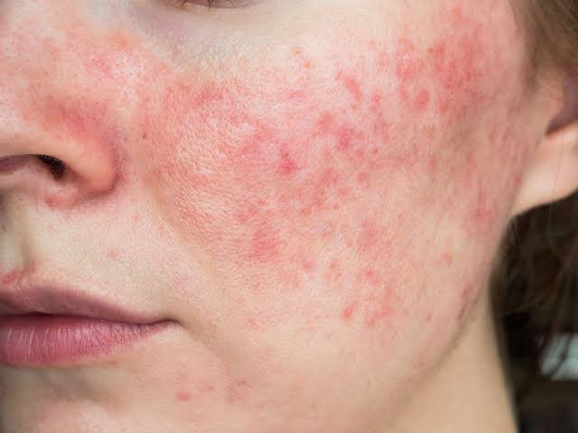 Understanding the Triggers and Symptoms of Rosacea
