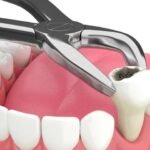 Tips for Preparing for Dental Extractions