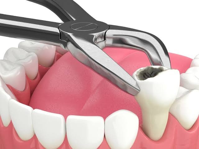 Tips for Preparing for Dental Extractions