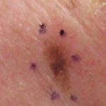 Aftercare Tips Following Skin Cancer Surgery