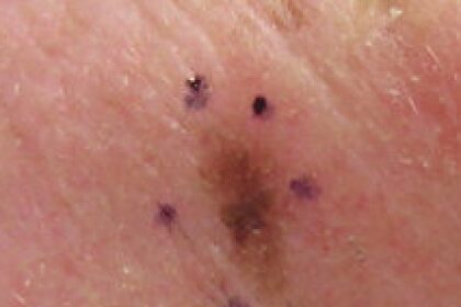Aftercare Tips Following Skin Cancer Surgery