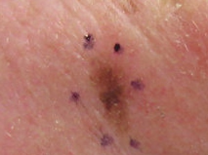 Aftercare Tips Following Skin Cancer Surgery