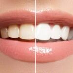Benefits of Professional Teeth Whitening Methods