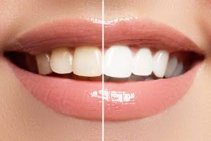 Benefits of Professional Teeth Whitening Methods