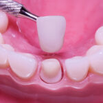 Exploring the Advantages of Crowns and Bridges in Dental Restorations