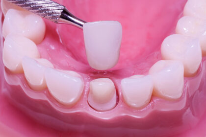 Exploring the Advantages of Crowns and Bridges in Dental Restorations