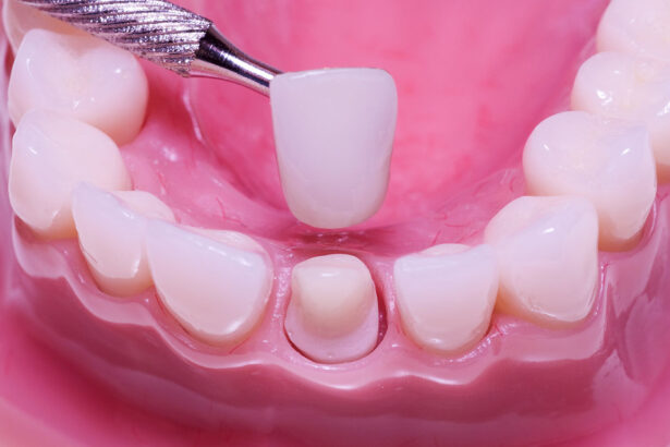 Exploring the Advantages of Crowns and Bridges in Dental Restorations