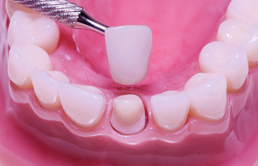 Exploring the Advantages of Crowns and Bridges in Dental Restorations