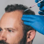 How To Prepare for Your PRP Hair Loss Appointment