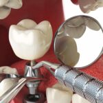 What To Expect During Your Dental Implant Procedure