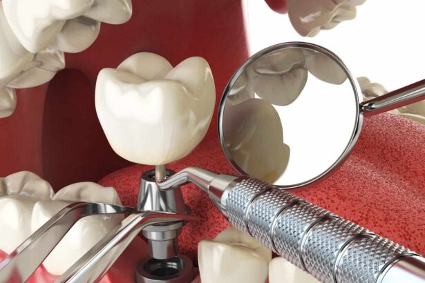 What To Expect During Your Dental Implant Procedure