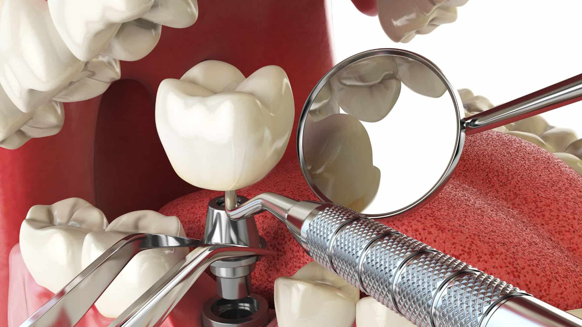 What To Expect During Your Dental Implant Procedure
